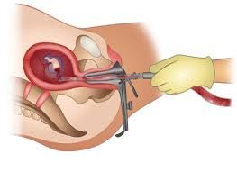 Types of Abortion Surgery