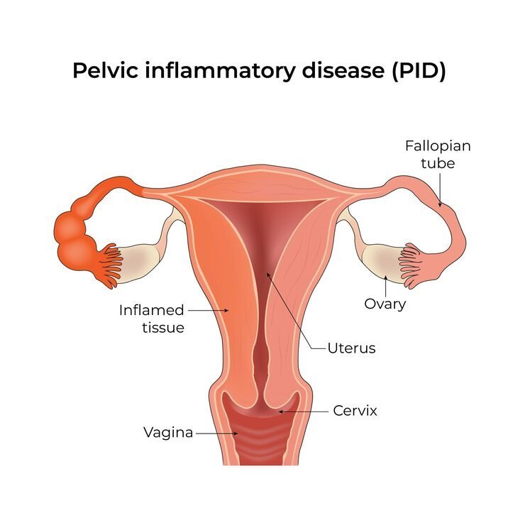 Pelvic Infections Treatment in Mumbai