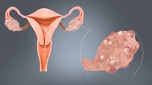 PCOS Surgery in Mumbai | Naraya Healthcare