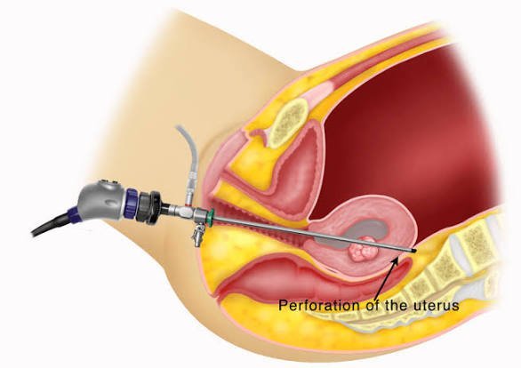 Diagnostic Laparoscopy and Hysteroscopy in Mumbai | Naraya