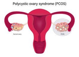 Why Choose PCOS Surgery in Mumbai?