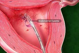 Endometrial Biopsy in Mumbai | Naraya Healthcare