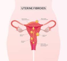 fibroids in Mumbai ultrasound diagnosis