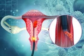 Endometrial biopsy procedure by gynecologist