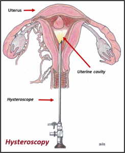 hysteroscopy procedure in mumbai