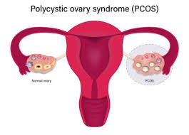 laparoscopic PCOS surgery treatment Mumbai
