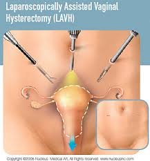 laparoscopic hysterectomy surgery in mumbai hospital