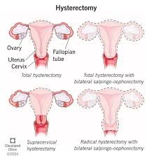 hysterectomy surgeries in mumbai for uterus removal