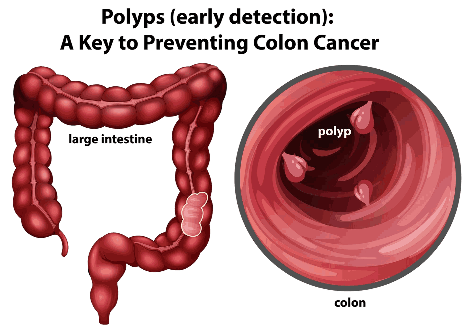 early detection colon polyps 11zon 1