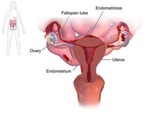 Endometriosis treatment by expert gynecologists in Mumbai